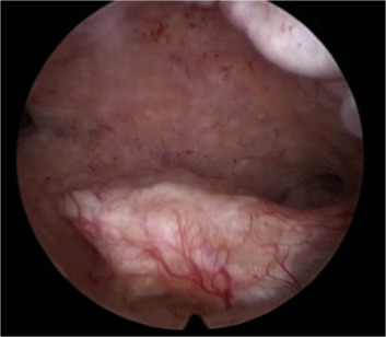 Operative Hysteroscopy (Complex-Fibroid)