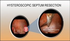 Operative Hysteroscopy (Complex-Septum)